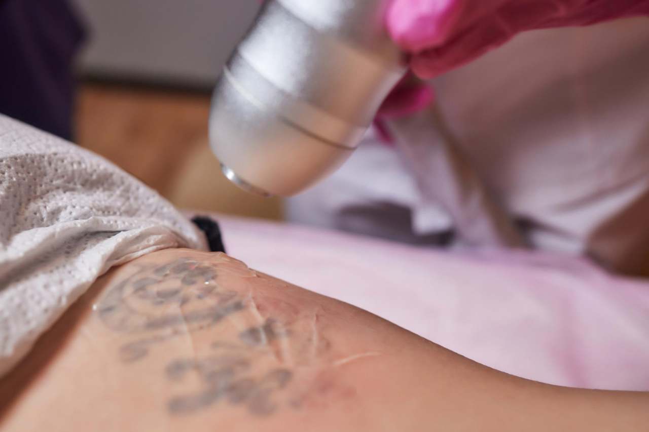 Láser para eliminación de tatuajes