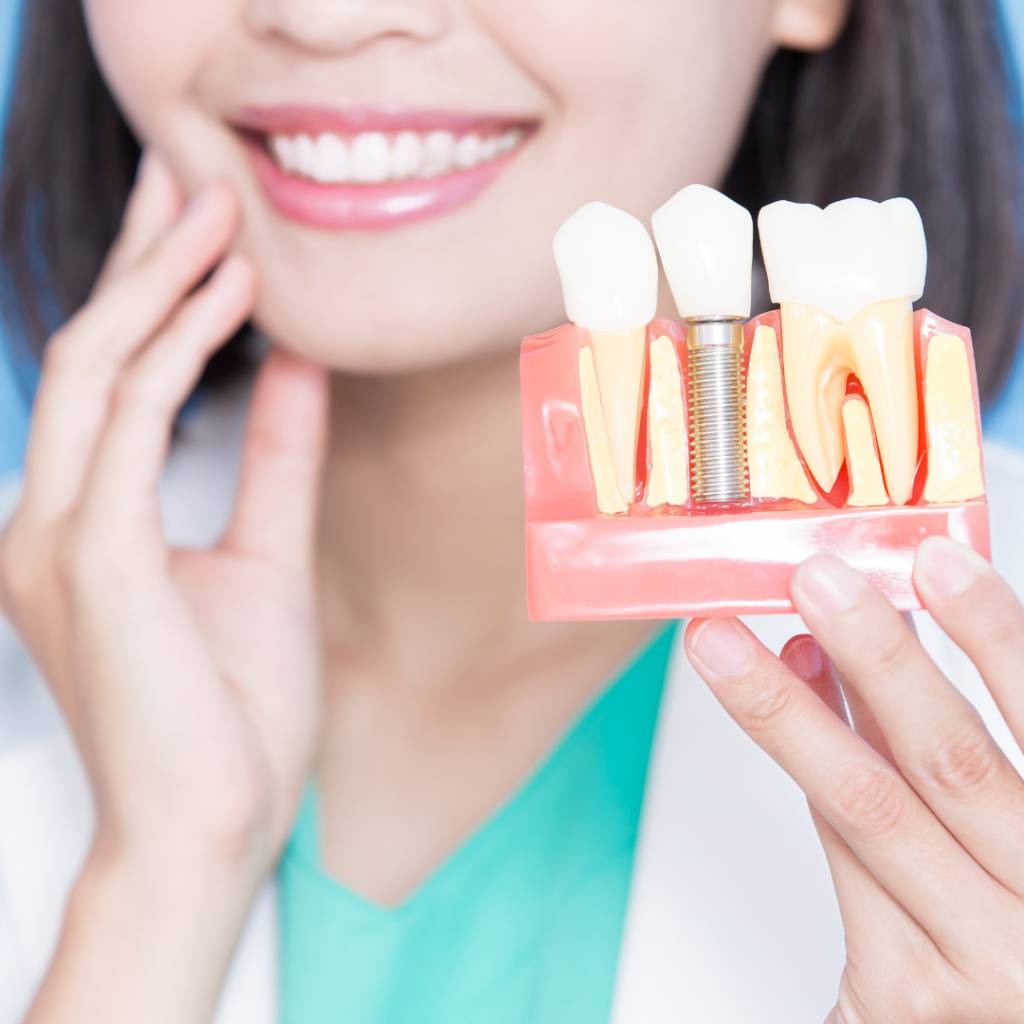 Implantes dentales