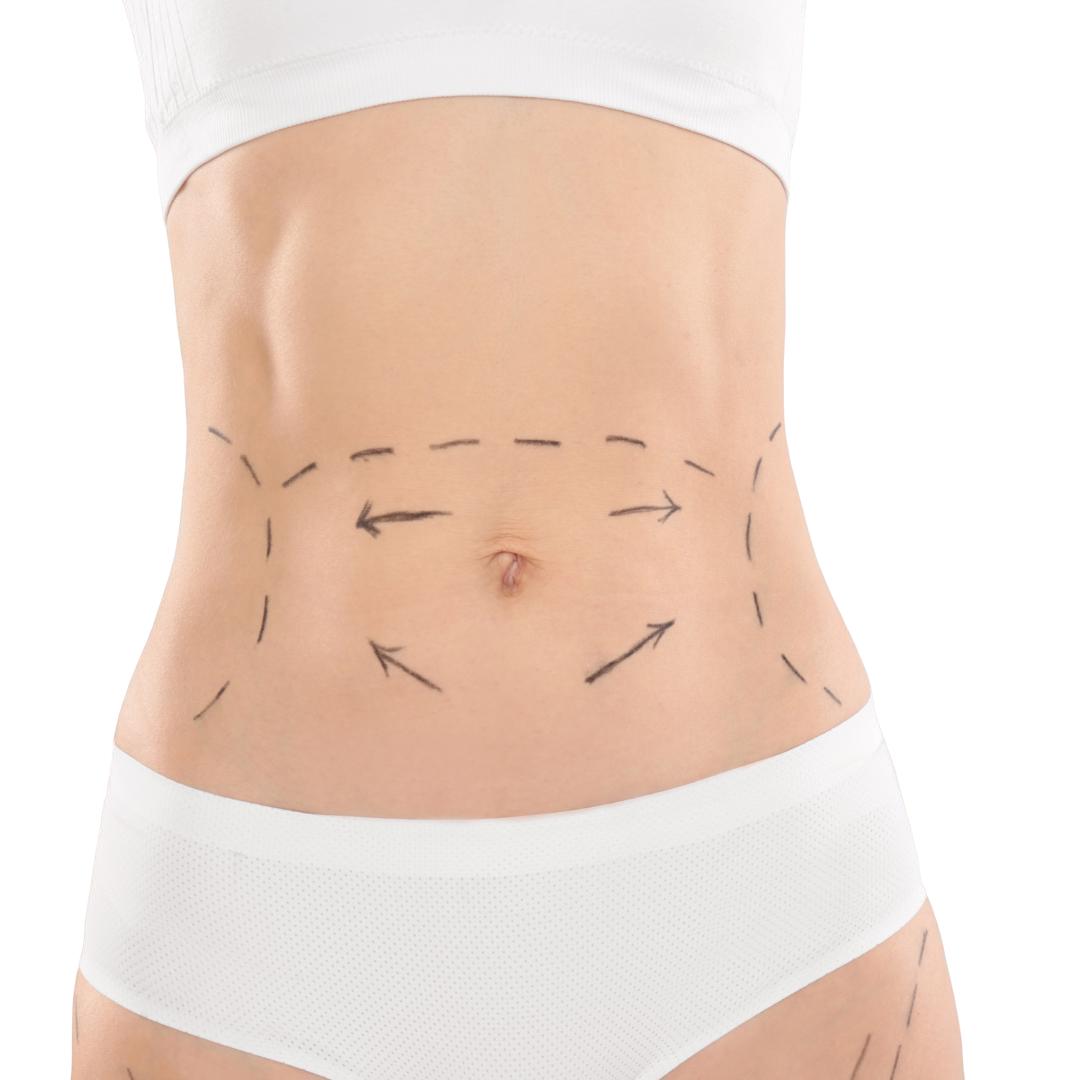 Abdominoplastia