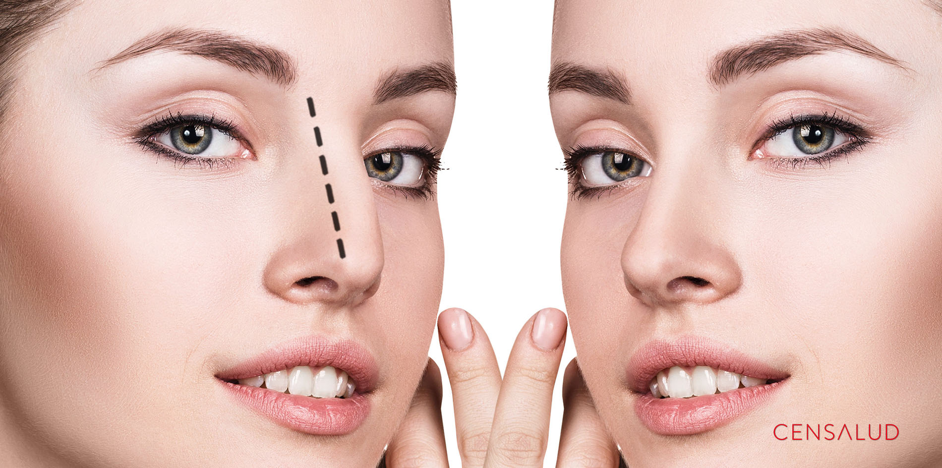 ¿En qué consiste una rinoplastia?