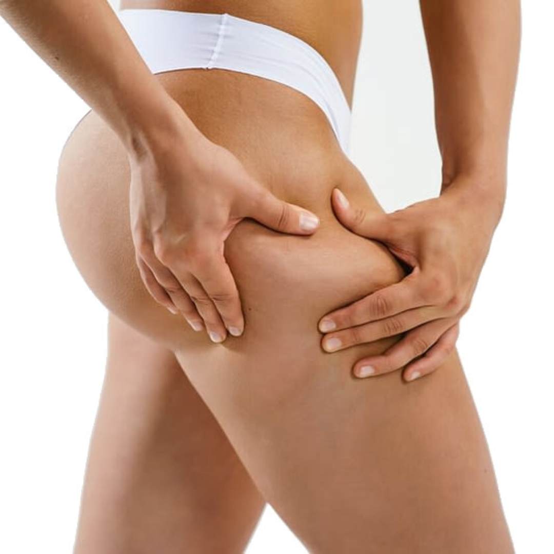 Celulitis