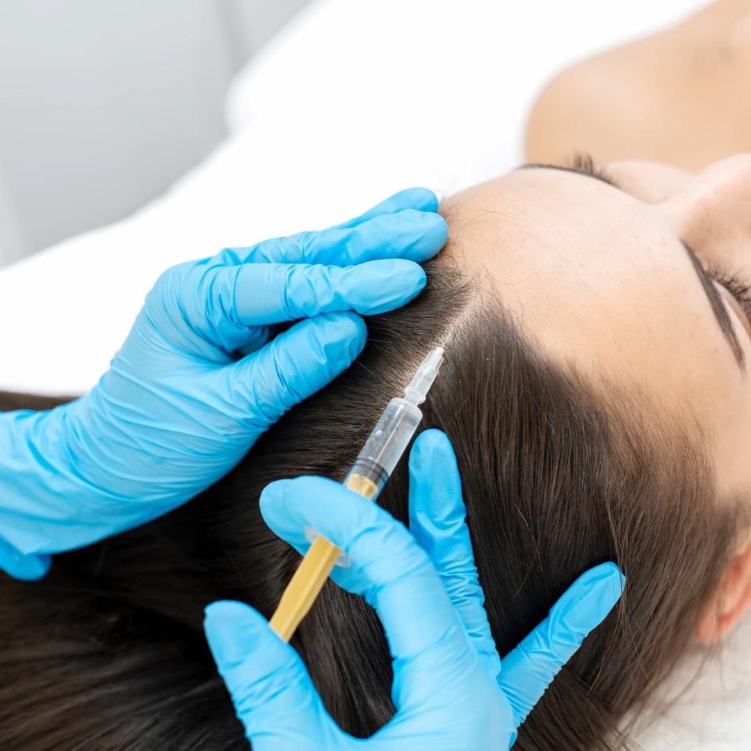 Mesoterapia capilar