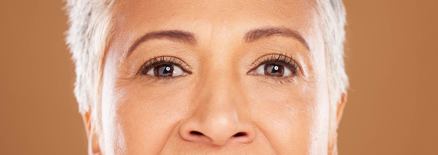 Arrugas estáticas: las que ya no se van