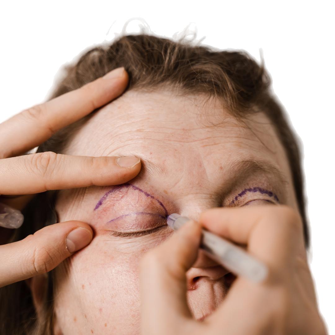 Blefaroplastia