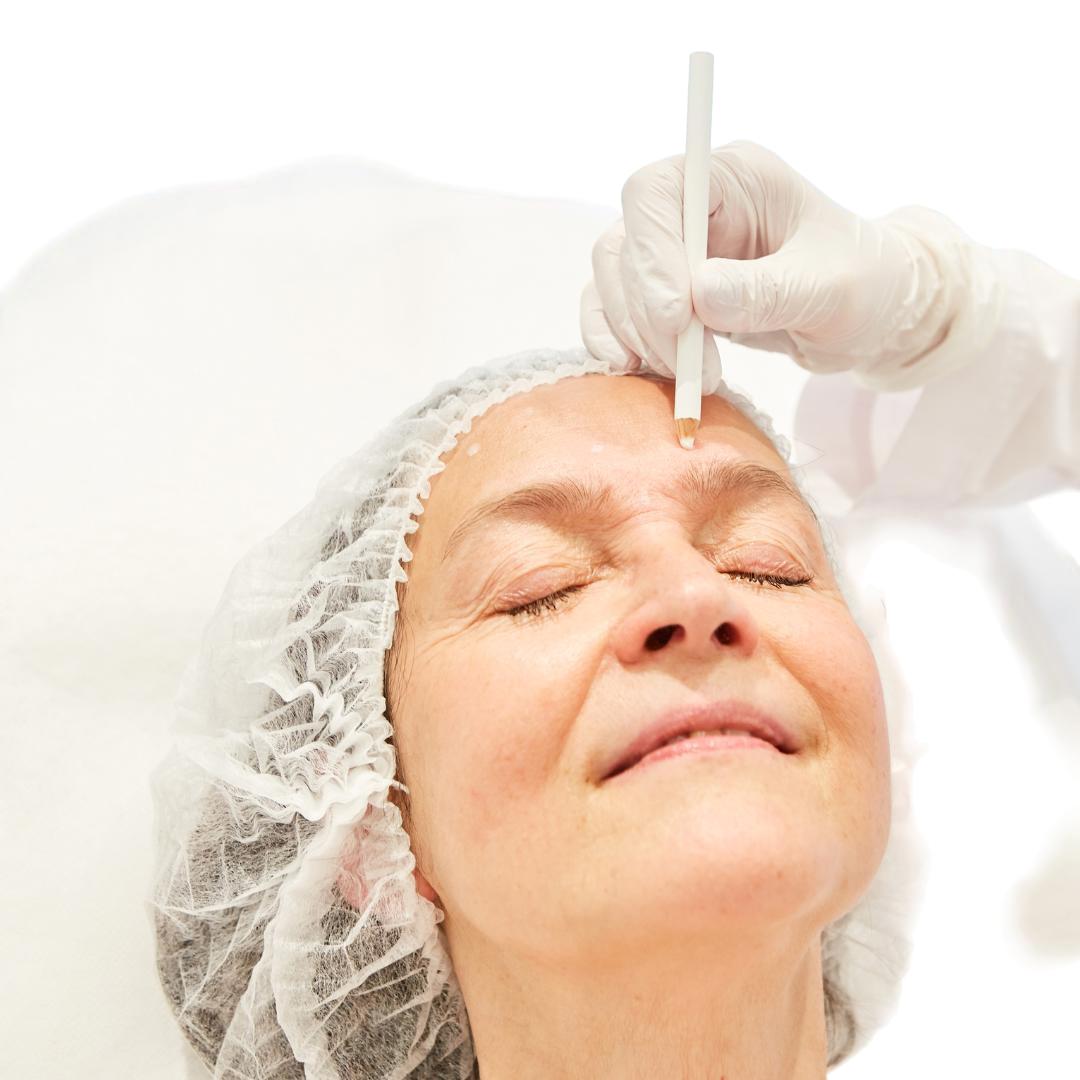 Lifting y minilifting facial quirúrgico