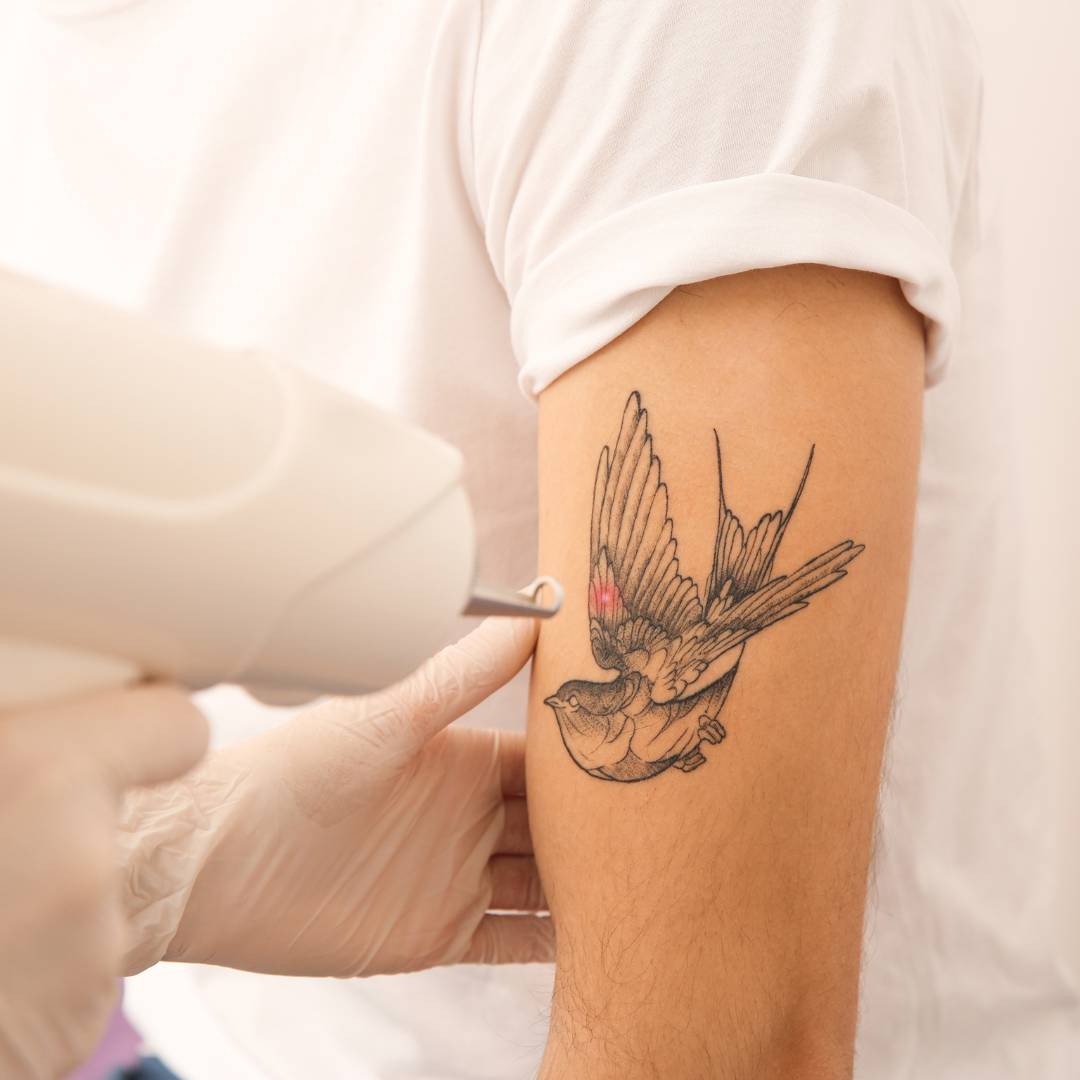 Eliminación de tatuajes