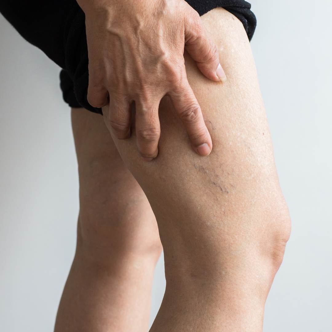 Varices